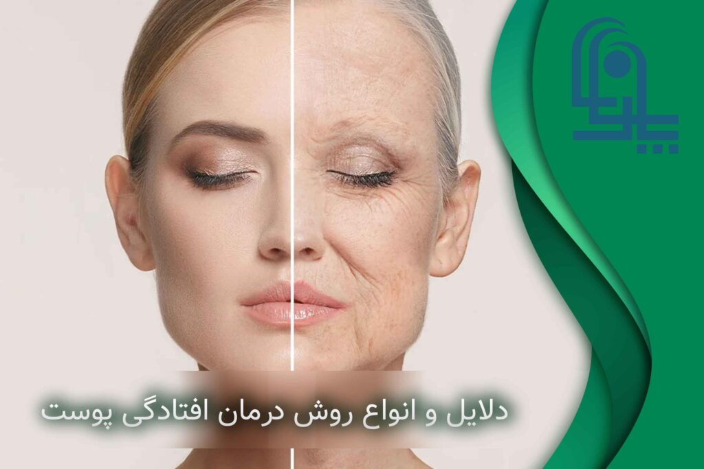 درمان و ویتامین برای جلوگیری از افتادگی پوست صورت