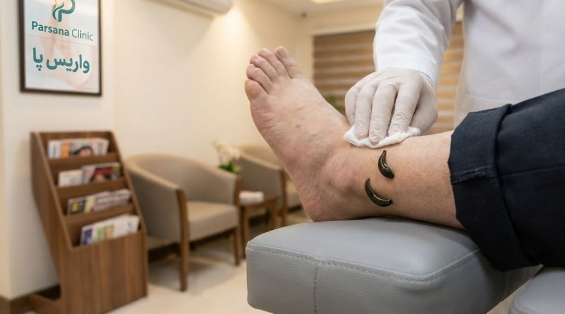 درمان واریس با زالو درمانی | رفع واریس با زالودرمانی